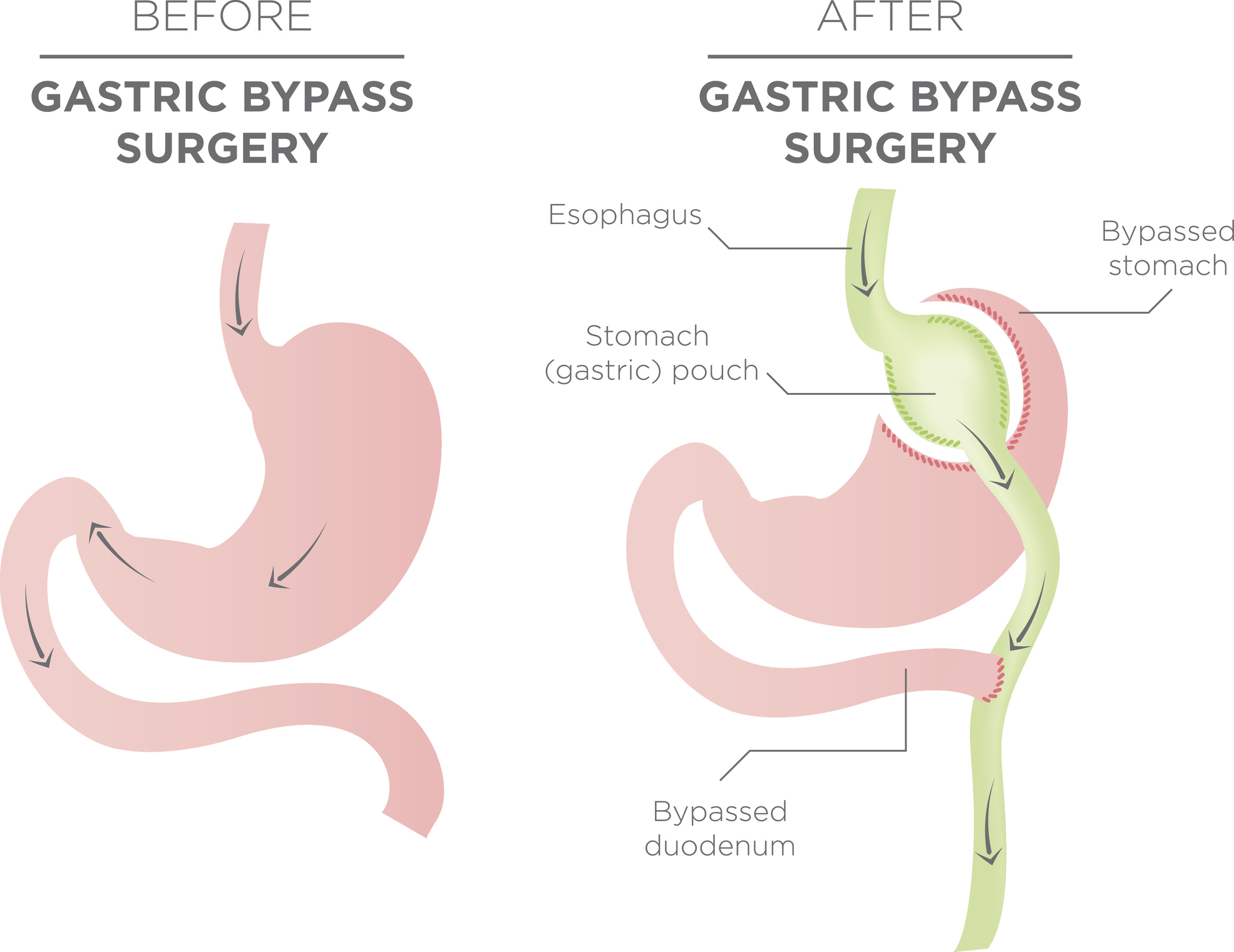 Weight Loss Surgery weight-loss-surgery