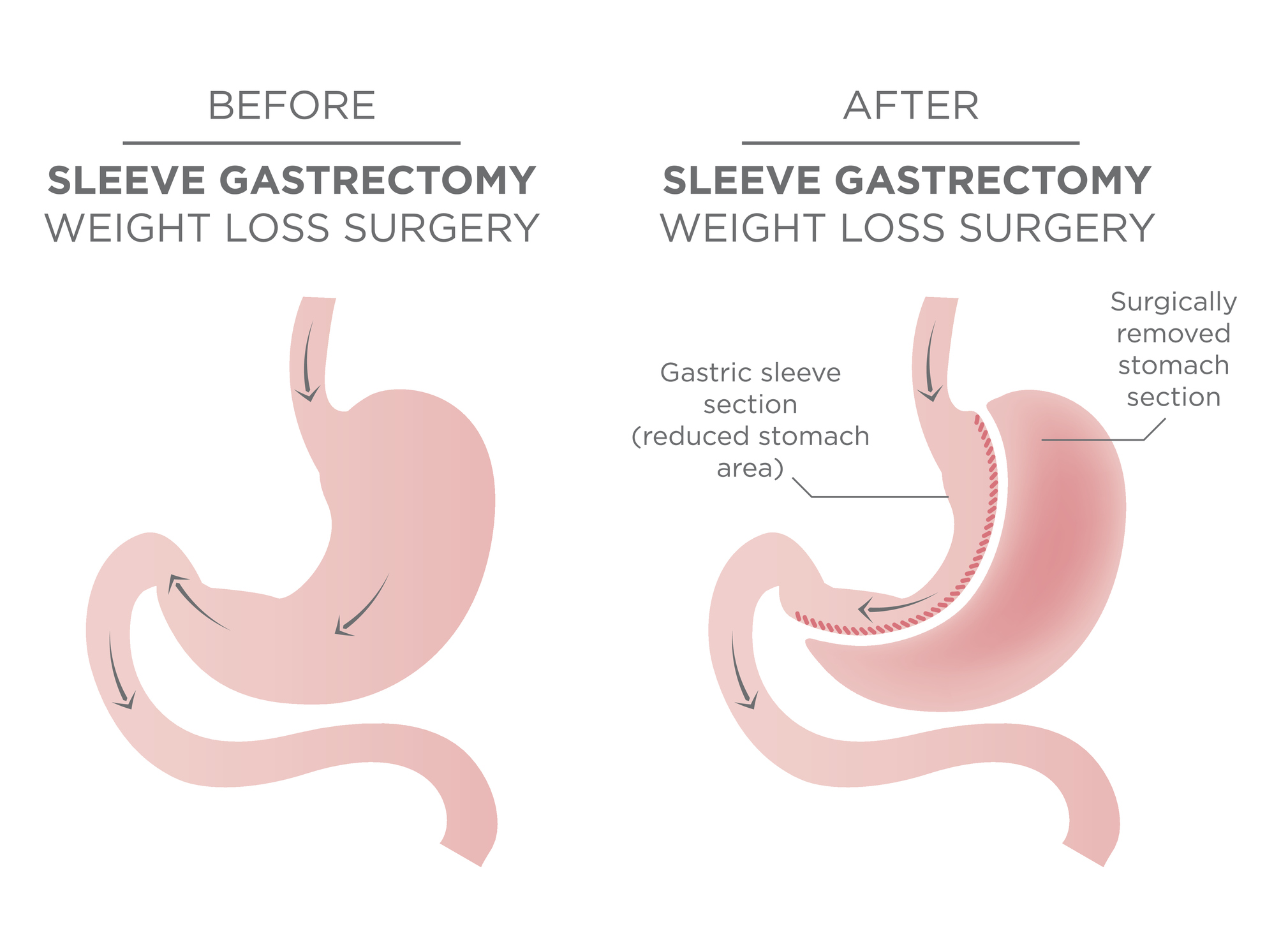 Gastric Sleeve.jpg
